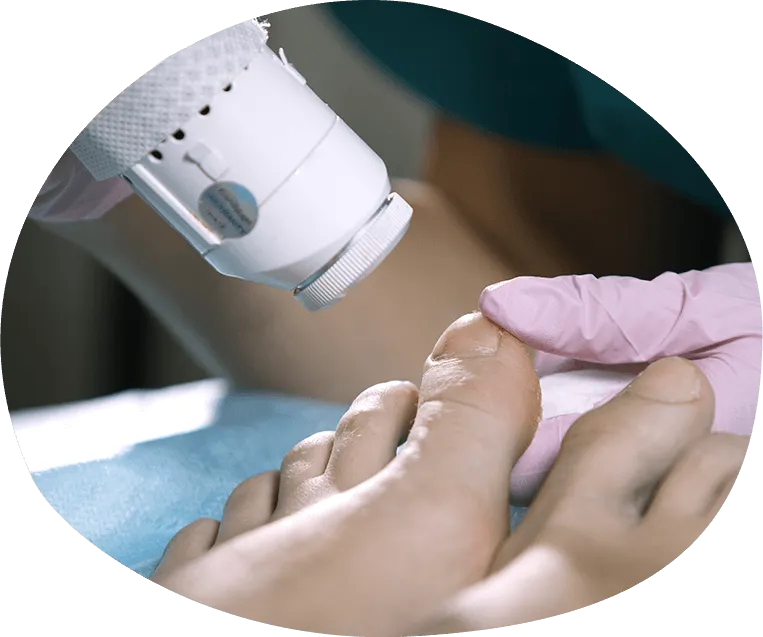 Adelaide Fungal Nail Laser Clinic