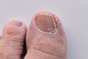 Adelaide Fungal Nail Clinic