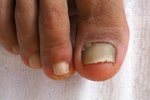 Adelaide Fungal Nails Clinic