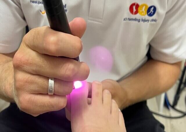 Hot Laser Treatment for Fungal Nails