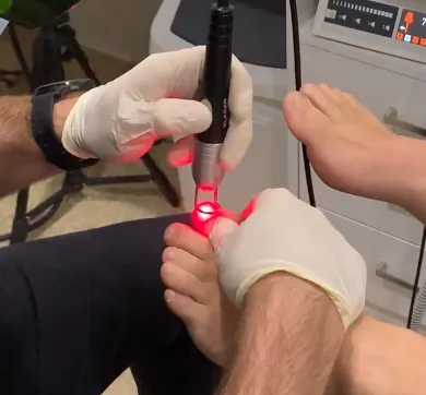 Laser Treatment Fungal Nail