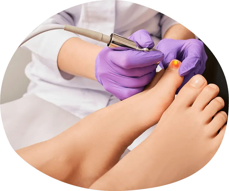 Hot laser treatment for fungal nails in Adelaide