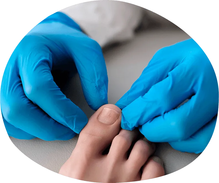 Toenail Fungus Adelaide